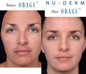 Obagi® Before and After Pictures – Micki Ly M.D. Maui Dermatologist